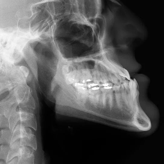 malocclusions