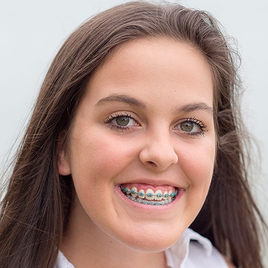 preventing-stains-braces