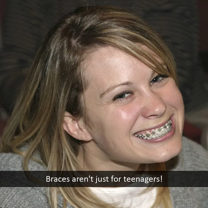 adult-braces