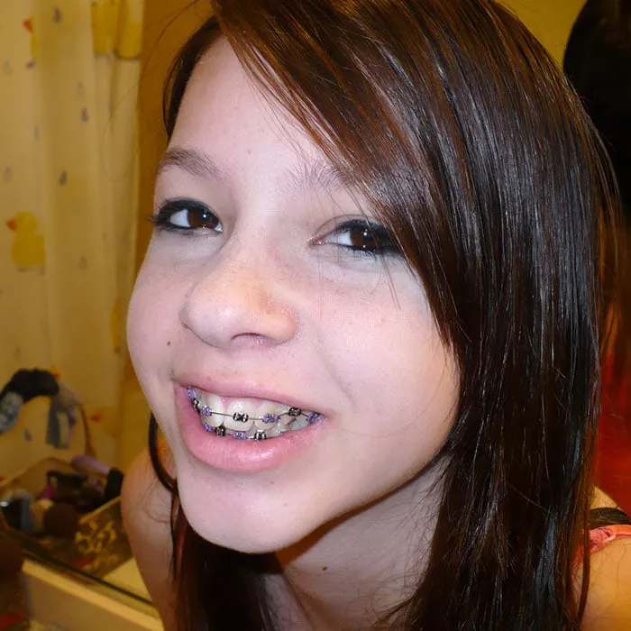 braces-care